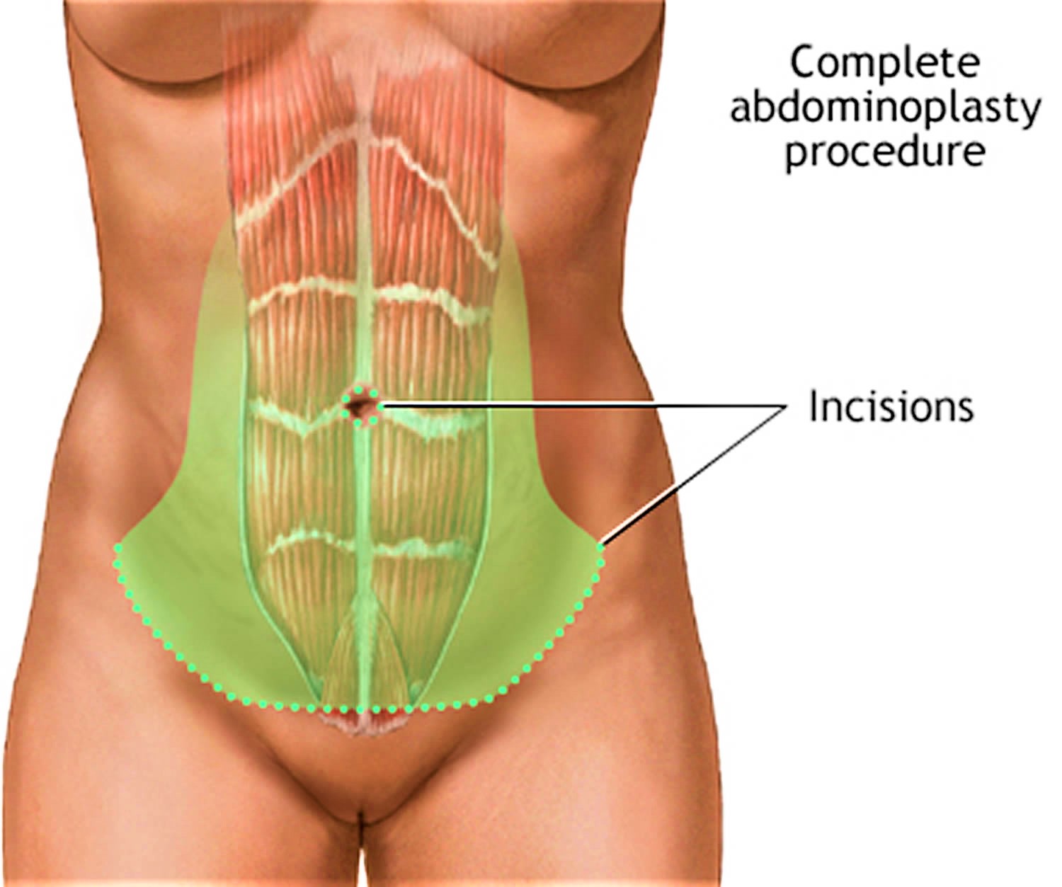 Abdominoplasty surgery