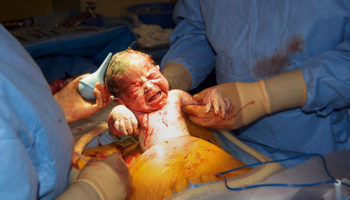 cesarean section