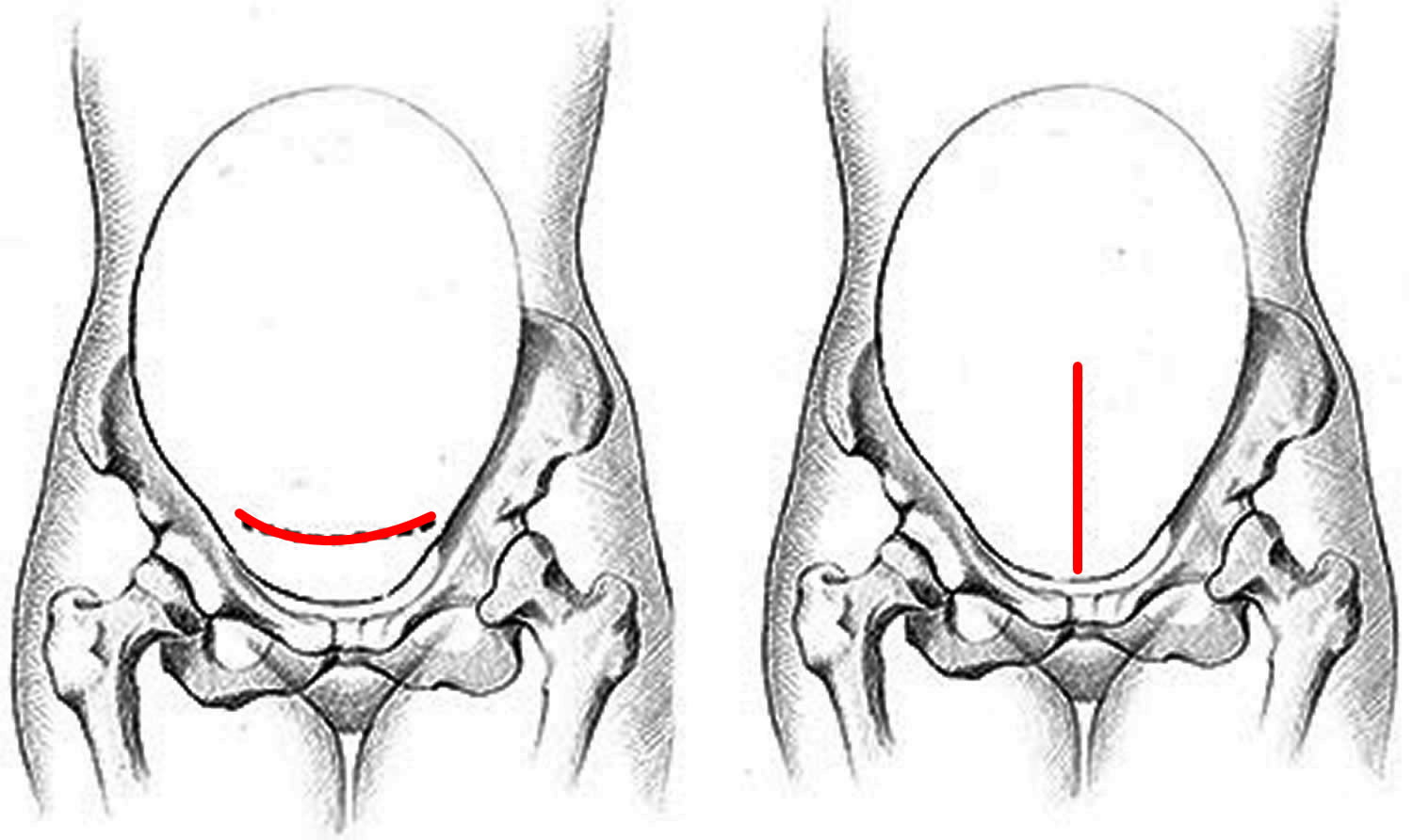 cesarean section abnormal presentation