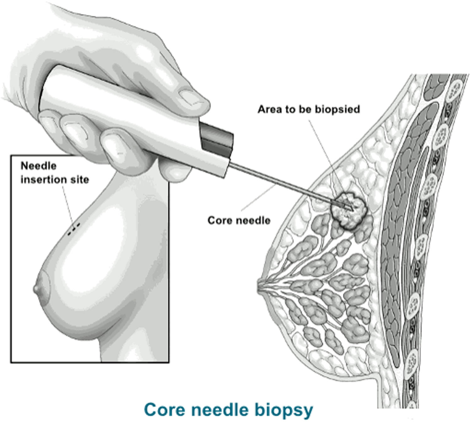 core needle breast biopsy