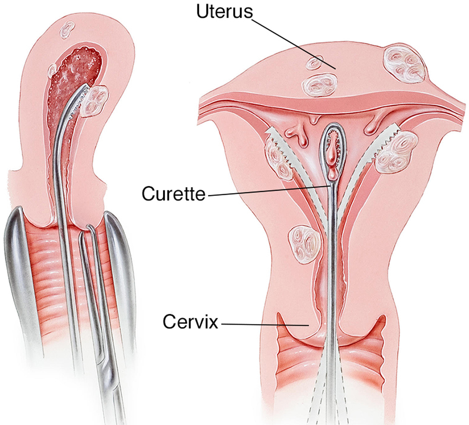 Mucus after miscarriage/incompetent cervix