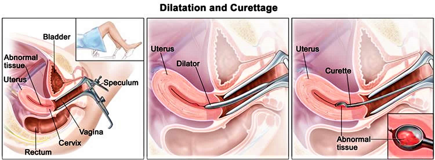 dilation and curettage
