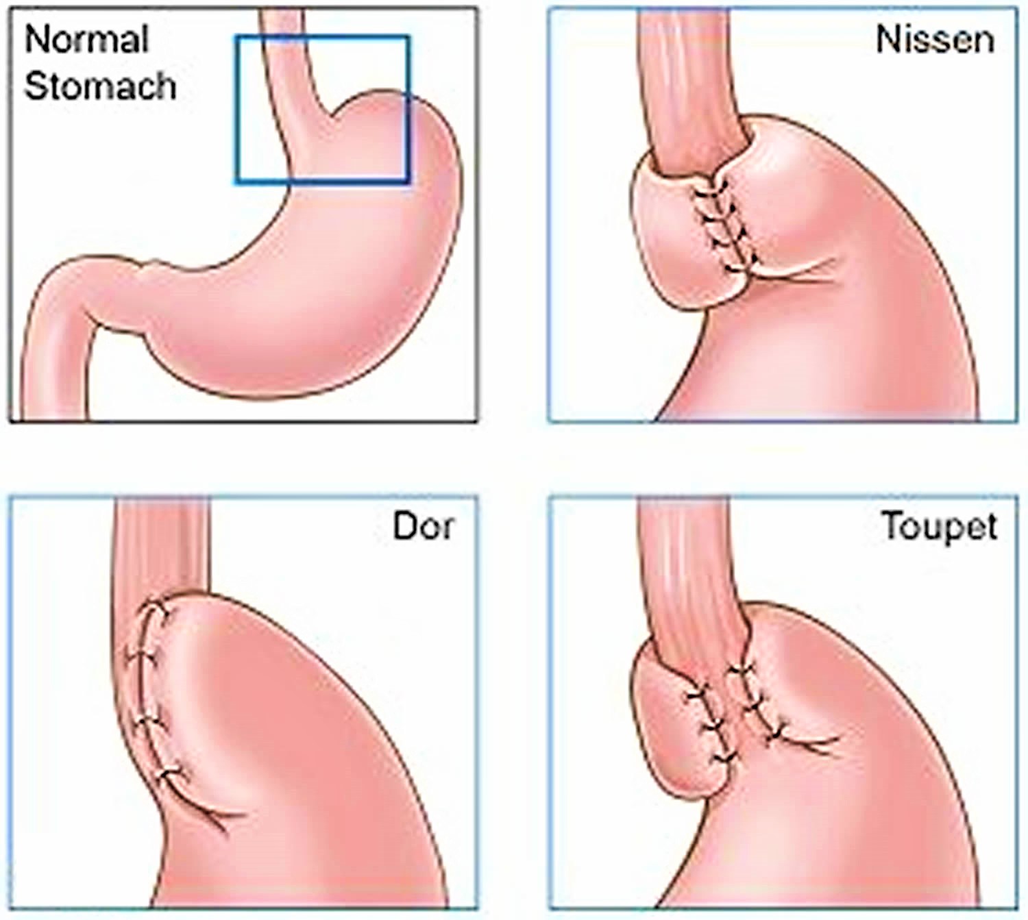 dor fundoplication