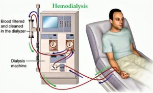 Hemodialysis - Procedure, Hemodialysis Side Effects