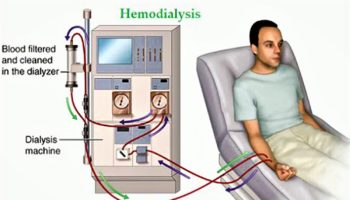 hemodialysis