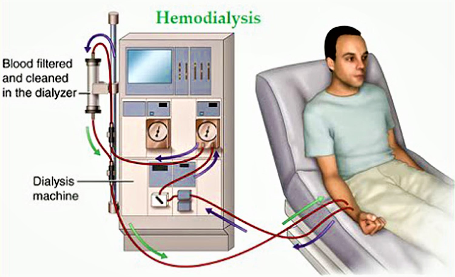 Hemodialysis Circuit Diagram