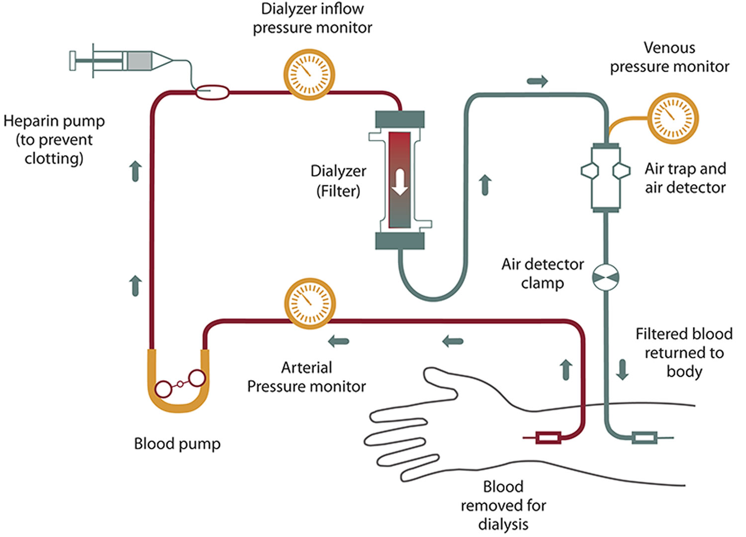 how hemodialysis work