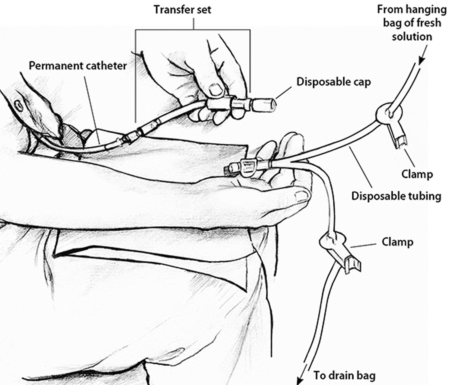how to connect your catheter to the transfer set to do your peritoneal dialysis