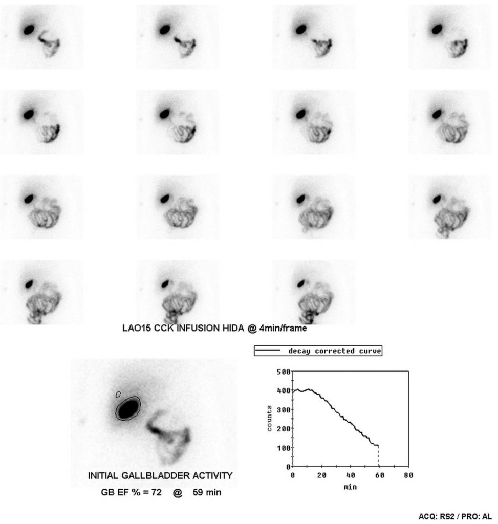 HIDA Scan Procedure Scan Results, Scan Side Effects