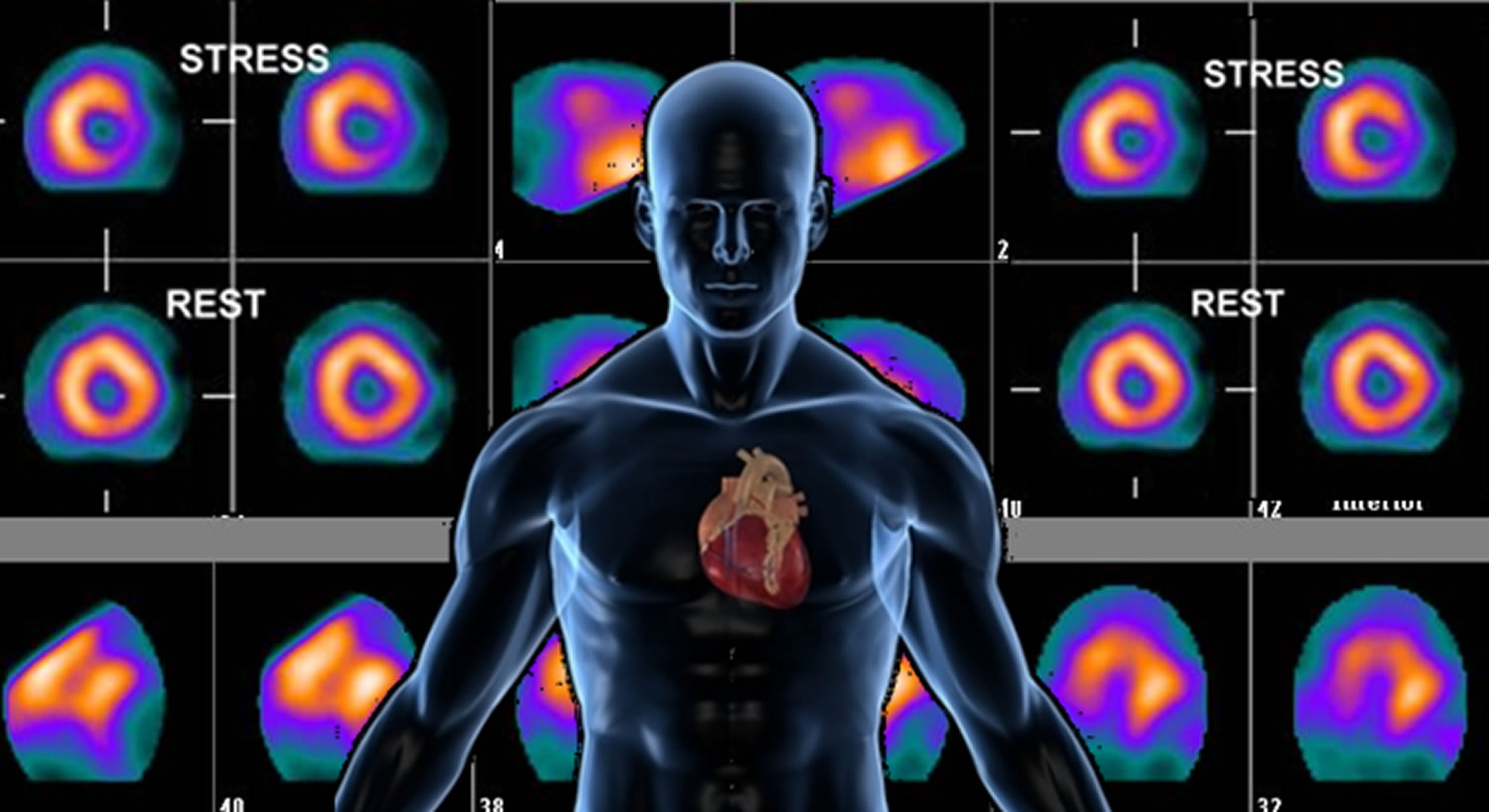 Nuclear Stress Test Prep Precautions After Side Effects