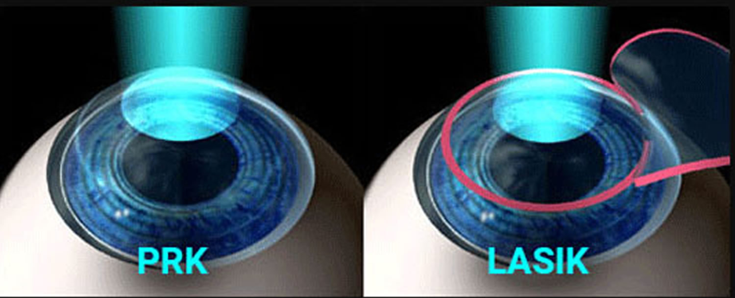 What is PRK (Photorefractive Keratectomy) | Millennium Laser Eye Centers