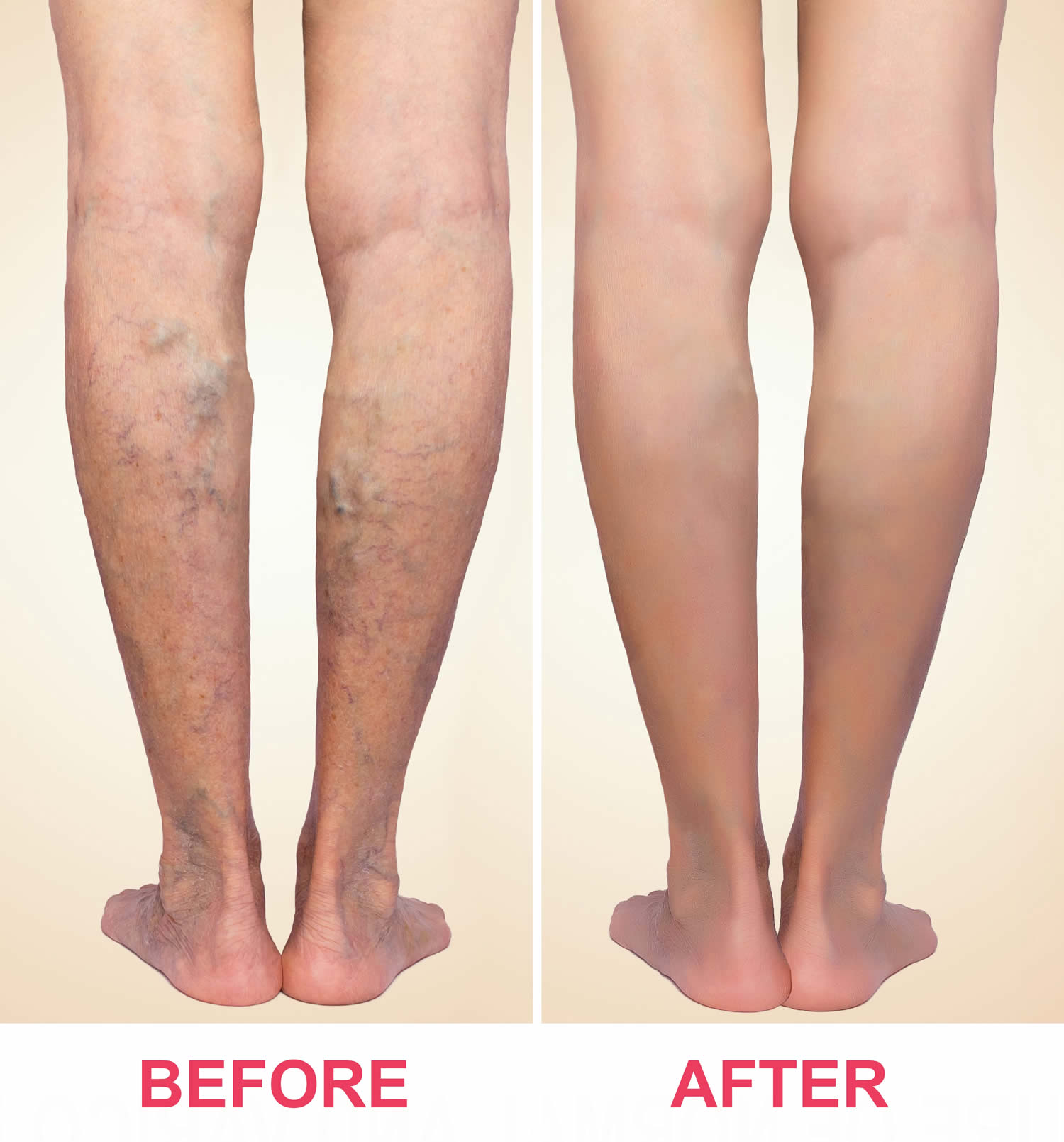 Collection 91+ Pictures
 sclerotherapy before and after pictures Updated