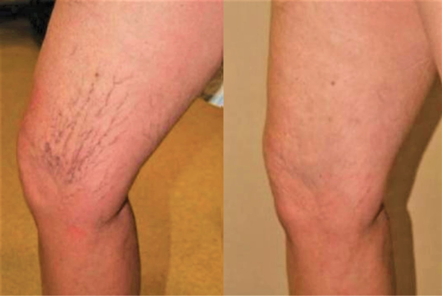 sclerotherapy before and after