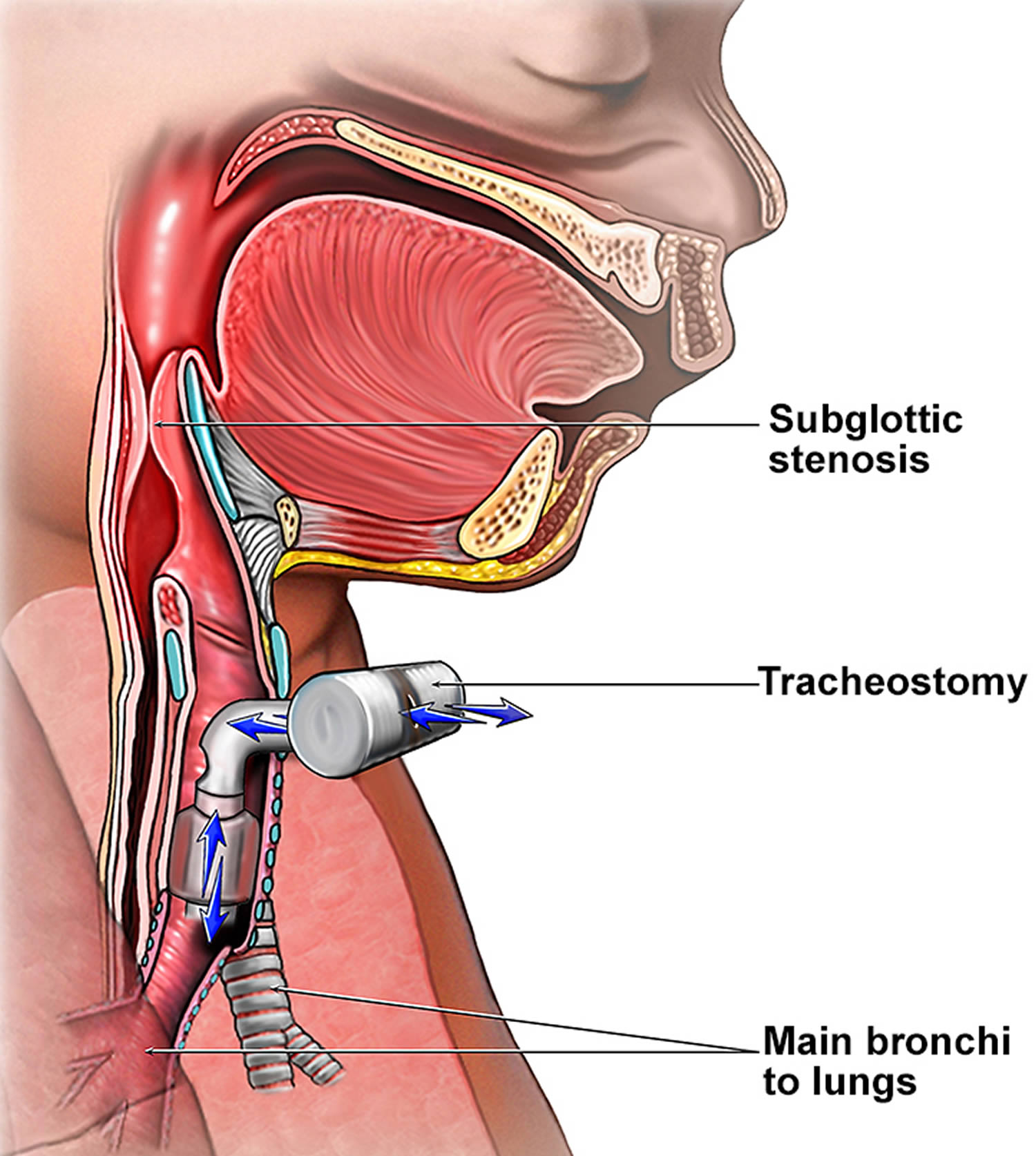 Tracheostomy - Procedure, Care, Tracheostomy Complications