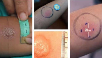 tuberculosis test
