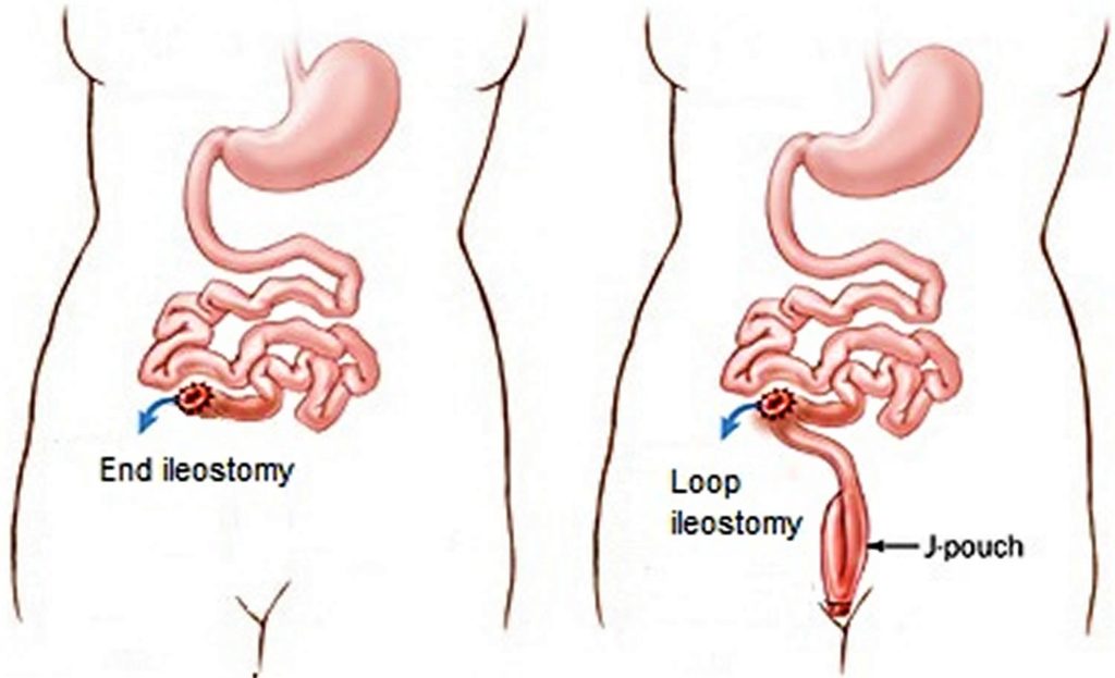 Ileostomy Loop Ileostomy, End Ileostomy, Diet, Complications