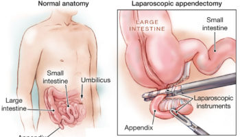 laparoscopic appendectomy