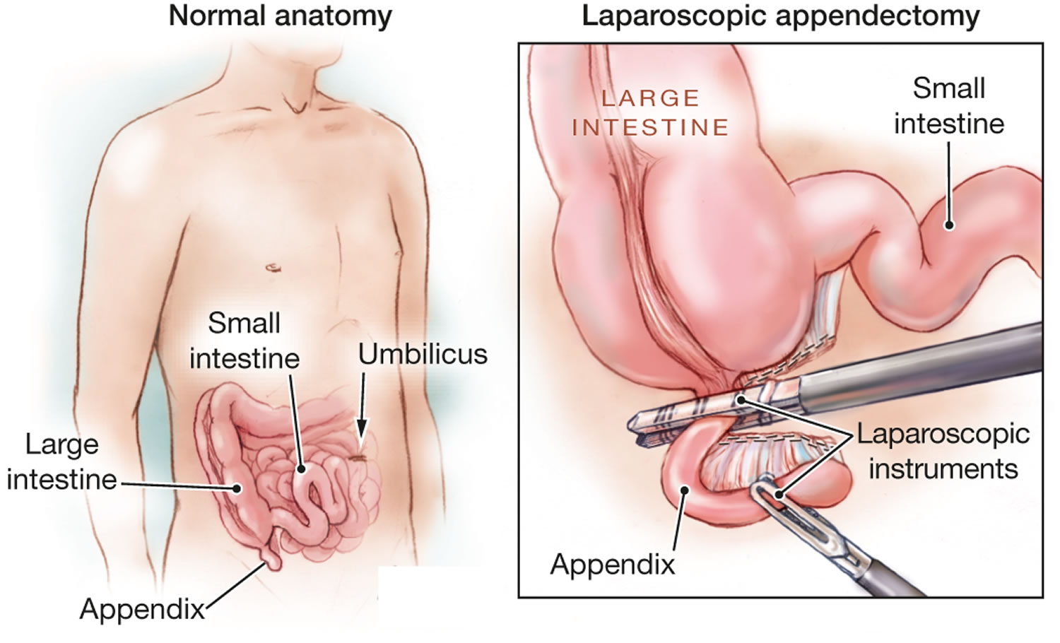 Laparoscopic Appendectomy