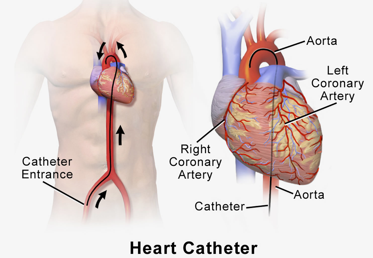 heart with dye test The Steps, Catheterization  Duration Procedure  Cardiac