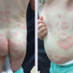 histamine intolerance