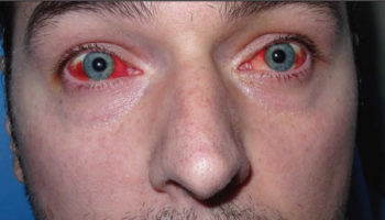 mycoplasma pneumoniae