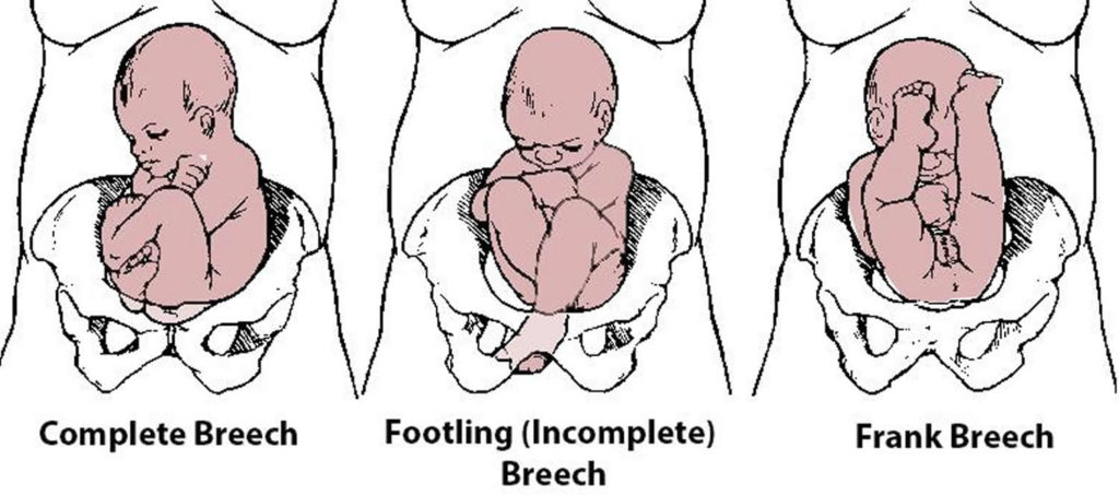 breech presentation in first pregnancy