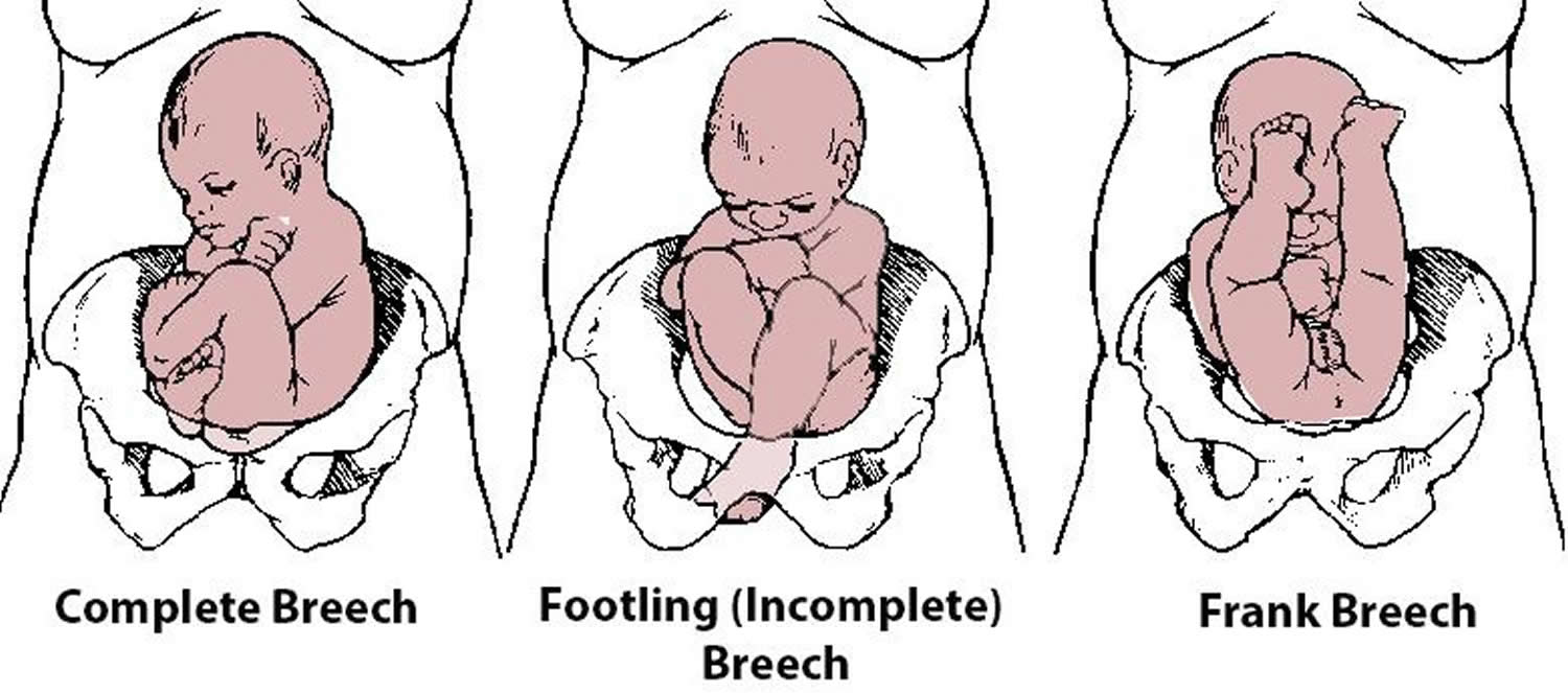 fetal presentation on breech