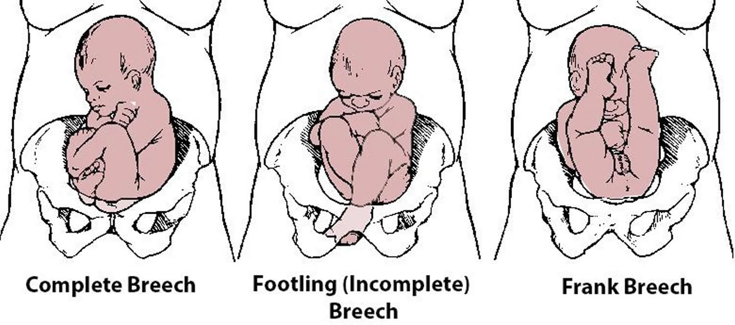 the fetus is in breech presentation