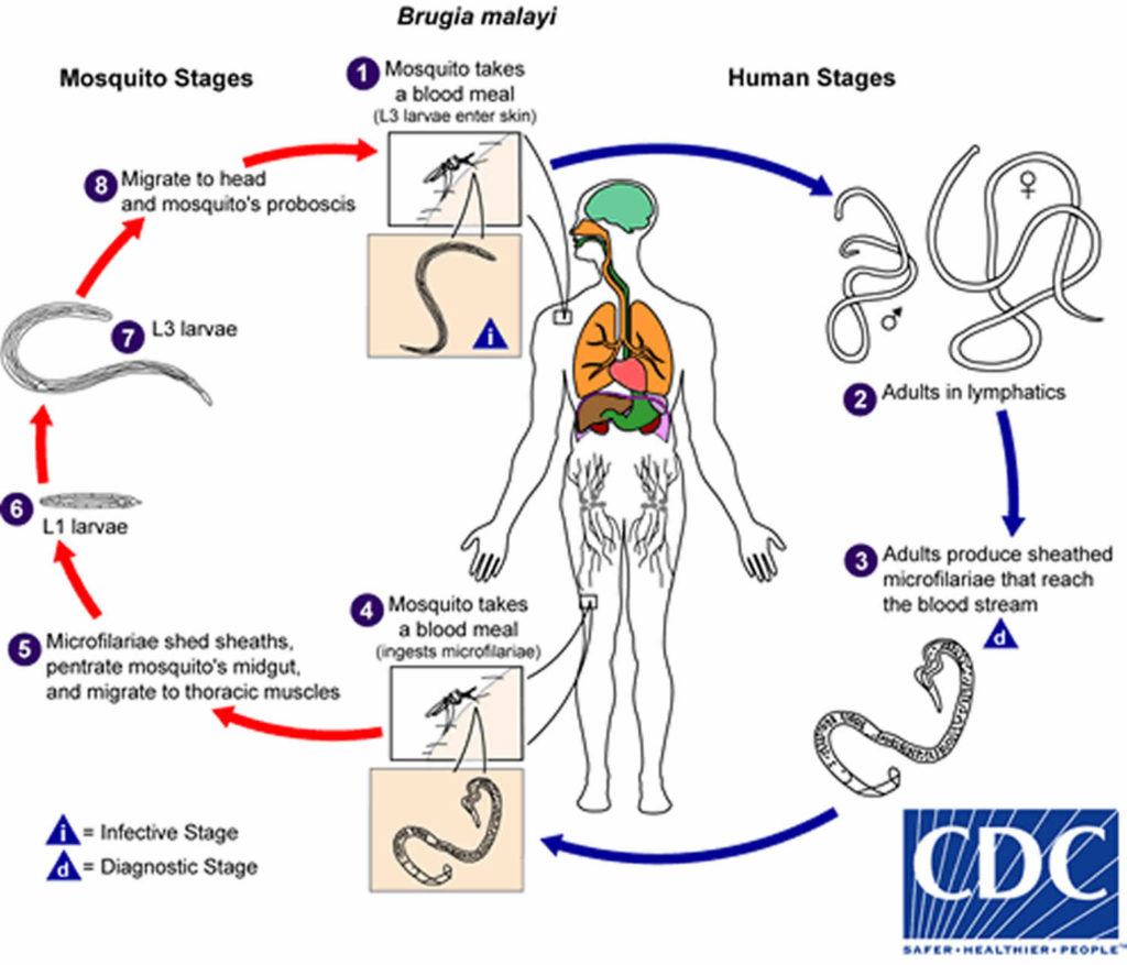 Elephantiasis disease causes, symptoms and elephantiasis treatment