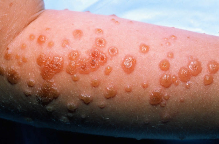 Erythema multiforme causes, types, symptoms, diagnosis and treatment