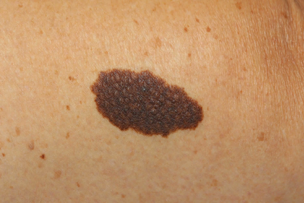 Birthmark causes, types of birthmarks and how to get rid of birthmarks