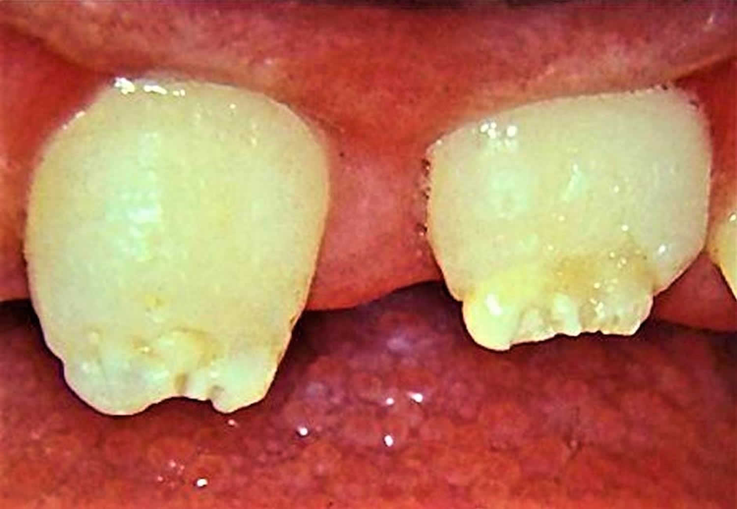 Congenital syphilis - Hutchinson’s teeth