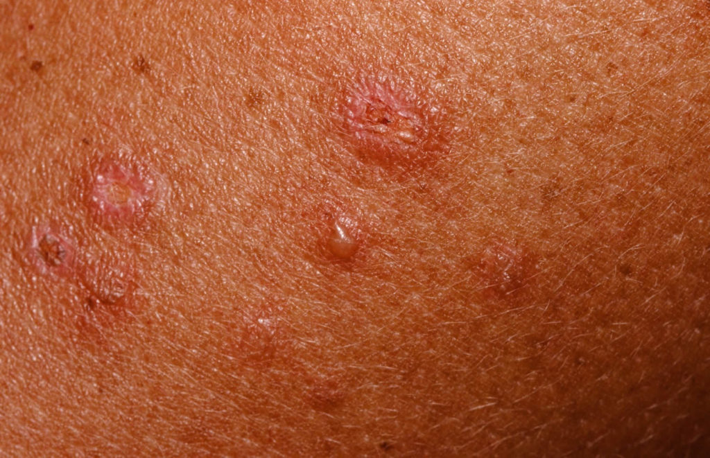 Dermatitis Herpetiformis Causes Symptoms Diagnosis And Treatment