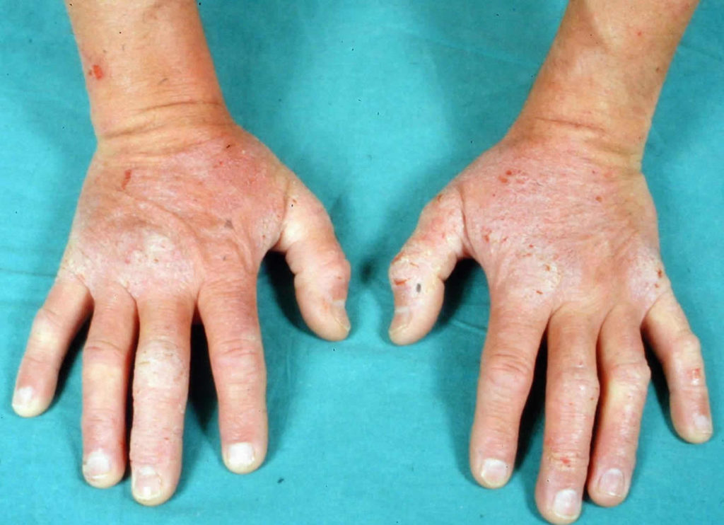 Dermatitis Herpetiformis Causes, Symptoms, Diagnosis And Treatment