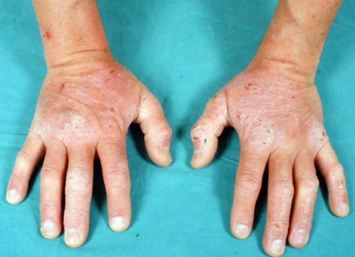 Dermatitis herpetiformis hands