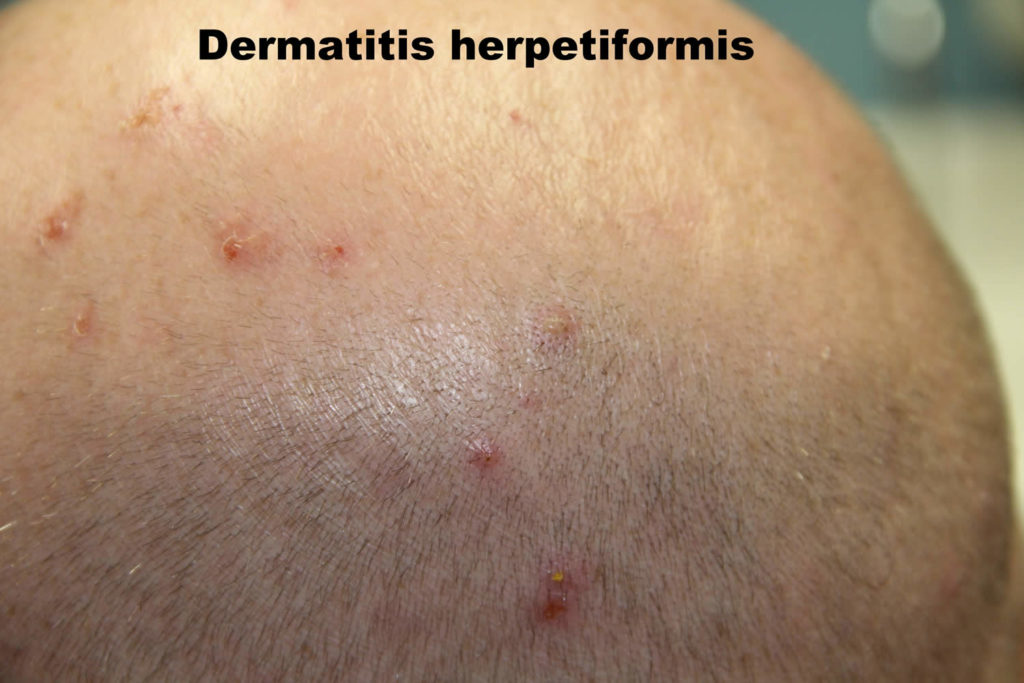 Dermatitis Herpetiformis Causes Symptoms Diagnosis And Treatment