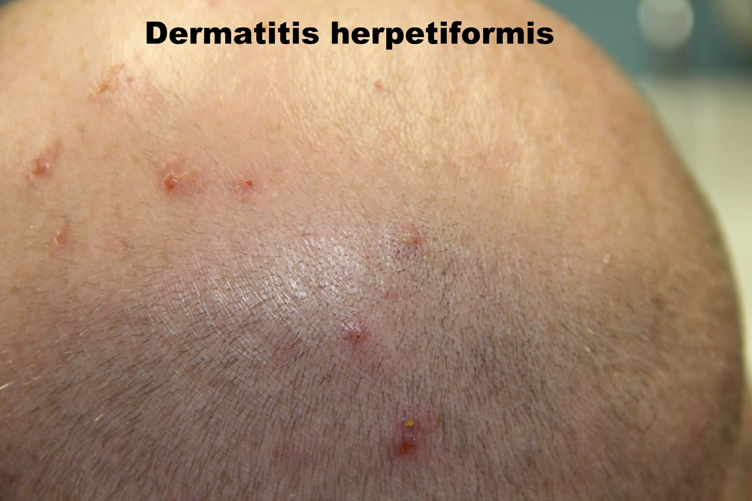 Dermatitis herpetiformis scalp