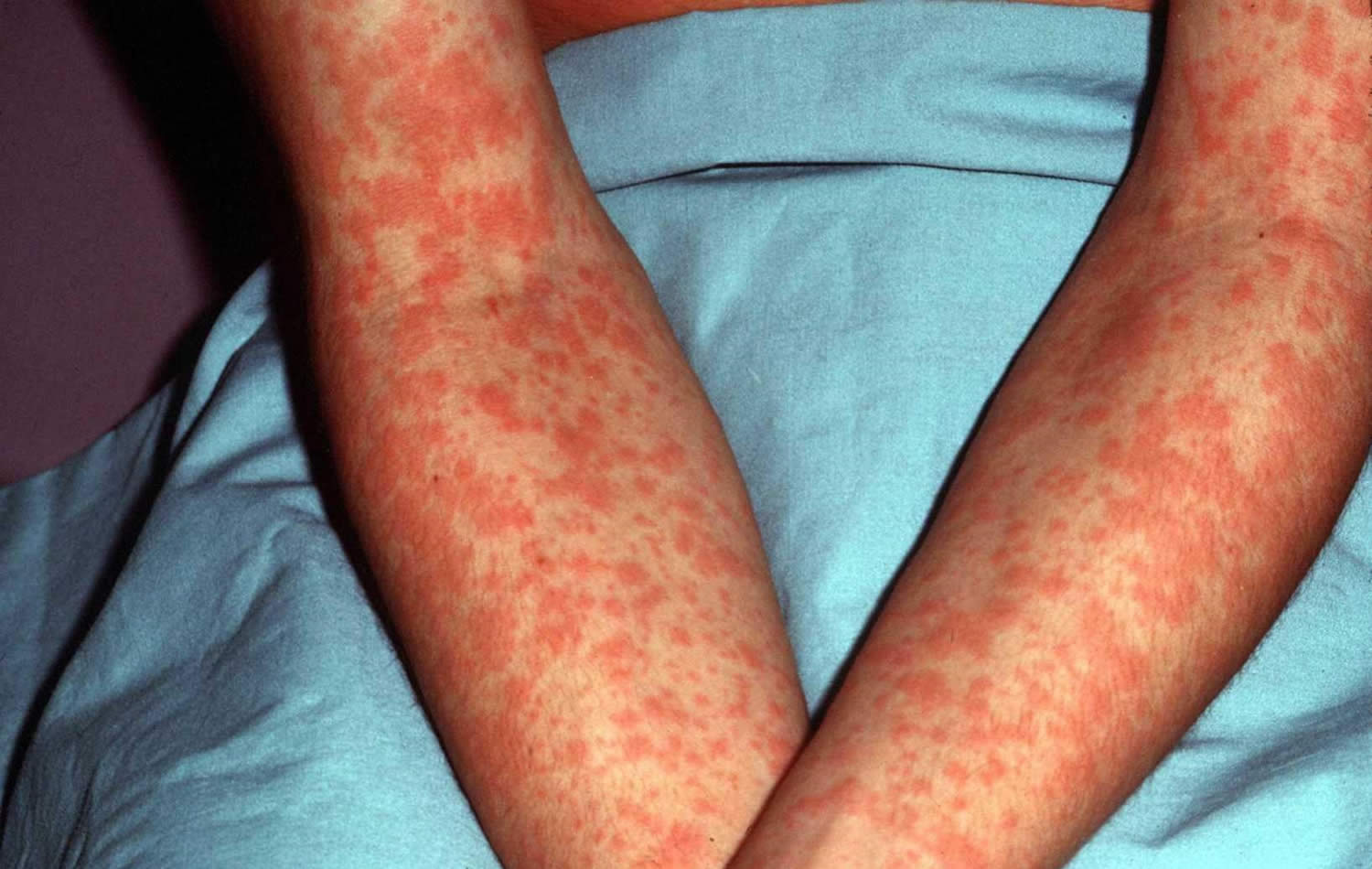 Epstein Barr virus rash