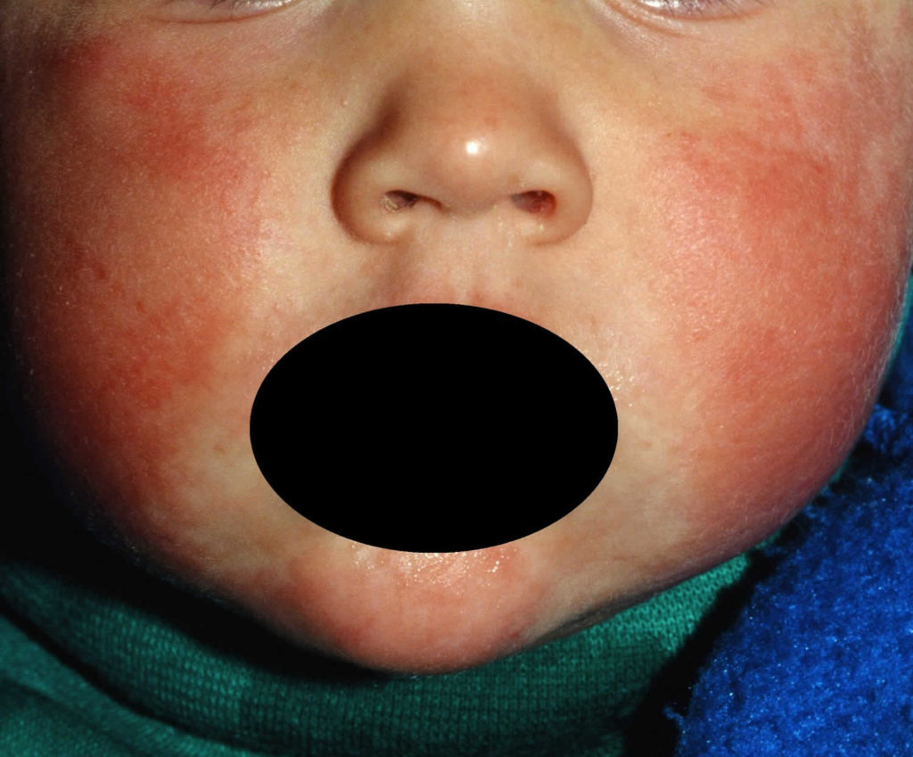 Fifth disease causes, incubation period, rash and fifth disease treatment