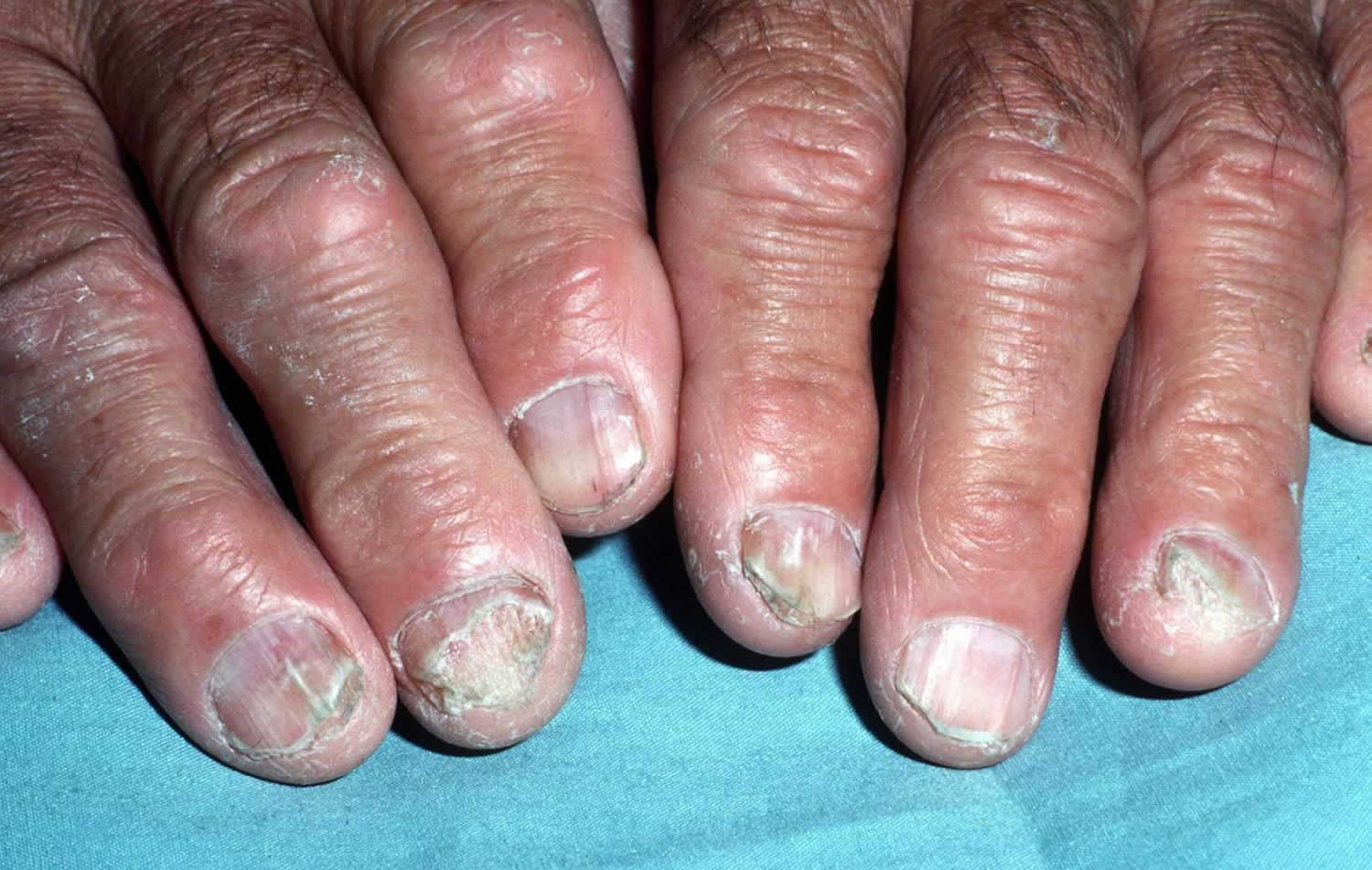 Nail Fungus Infection Causes And How To Get Rid Of Nail Fungus Infection