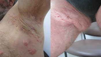 hidradenitis suppurativa