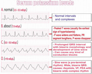 Hyperkalemia causes, signs, symptoms, ECG changes and treatment