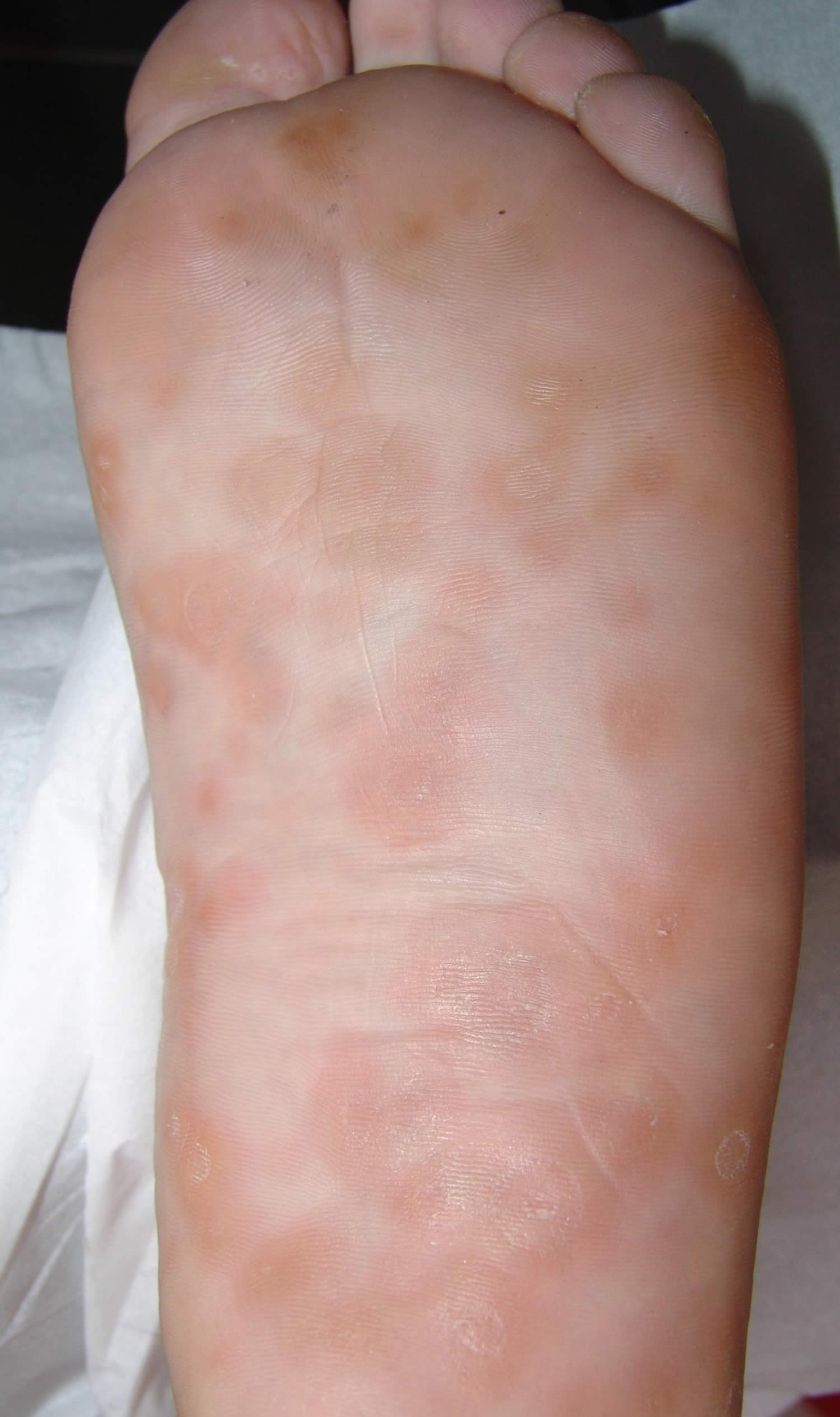 Secondary syphilis foot rash