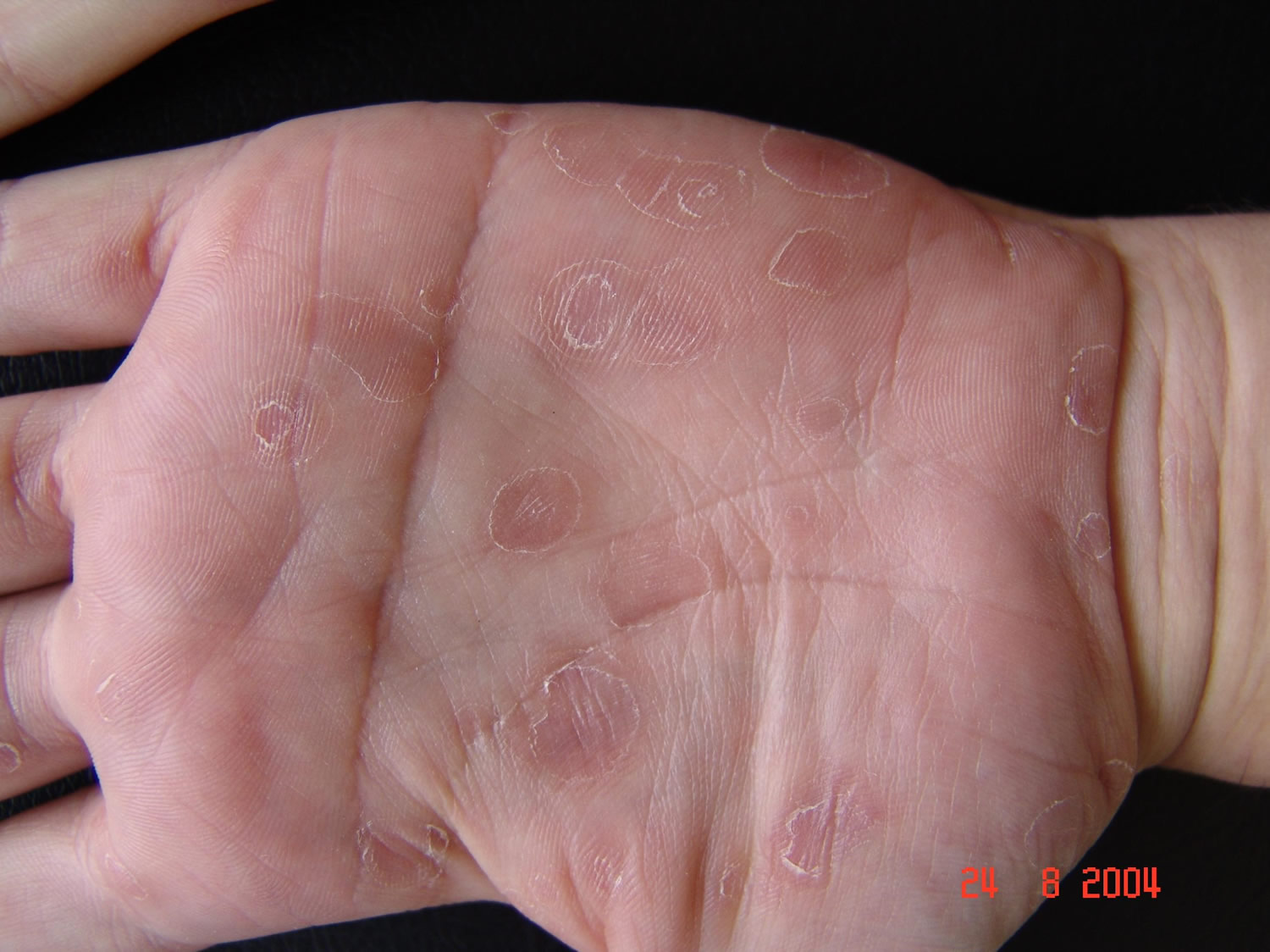 Secondary syphilis hand rash