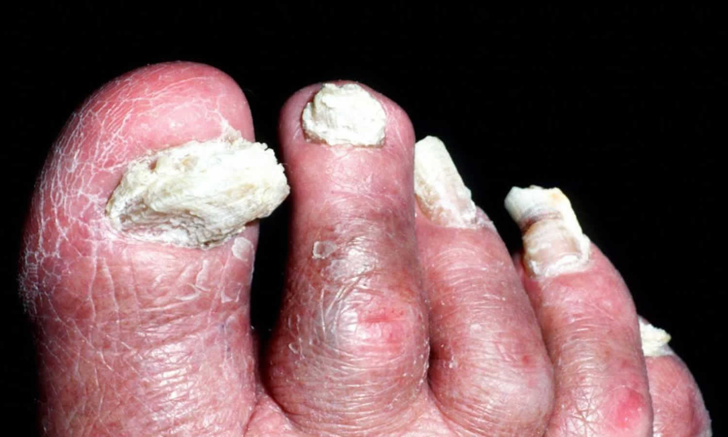 Nail fungus infection, causes and how to get rid of nail fungus infection