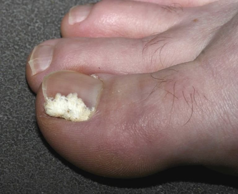 Can Toe Infection Go Away On Its Own