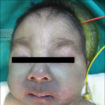 Trisomy 18 baby