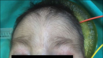 Trisomy 18 baby