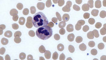 agranulocytosis