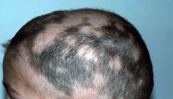 alopecia areata